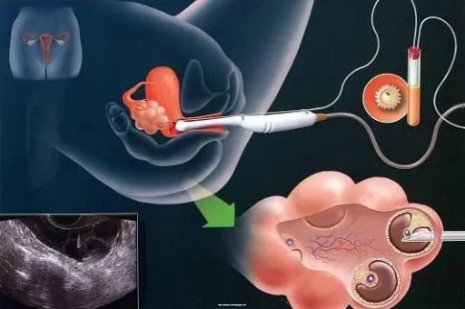 试管共享!宫外孕手术多少钱_宫外试管怀孕了打掉要多少钱|评论